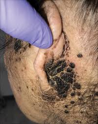 Find out about the causes, symptoms, diagnosis, types and stages of middle and inner ear cancer. Bilateral Brown Plaques Behind The Ears Mdedge Dermatology