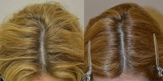 Clinical drug investigation 29.5 (2009): Finasteride Females Before After Photos Hair Restoration Of The South New Orleans La