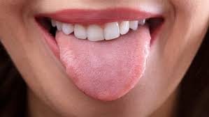 Jul 07, 2021 · asherettle july 07, 2021. Ø¹Ù„Ø§Ø¬ ØªÙ‚Ø±Ø­Ø§Øª Ø§Ù„Ù„Ø³Ø§Ù† Ø¨Ø§Ù„Ø£Ø¹Ø´Ø§Ø¨ ÙˆØ¨Ø¯ÙˆÙ† Ø·Ø¨ÙŠØ¨