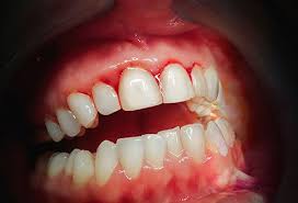 How do health care professionals diagnose gum disease? What Is Gingivitis Treatment Symptoms Home Remedies Causes