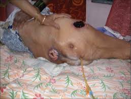 Eschar may be black, brown, or tan in appearance. View Image