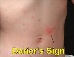 Systemic Mastocytosis - Ask Hematologist | Understand Hematology
