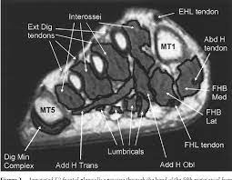 Foot positioned for axial images of the ankles; Pdf Intrinsic Muscle Atrophy And Toe Deformity In The Diabetic Neuropathic Foot A Magnetic Resonance Imaging Study Semantic Scholar