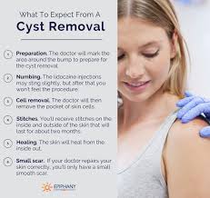 See full list on doctorshealthpress.com What To Expect From A Cyst Removal The Best Cyst Removal Treatment