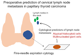 The reported incidence of mcc has more than tripled in the past 20 years1. Cancers Free Full Text Atypical Histiocytoid Cells And Multinucleated Giant Cells In Fine Needle Aspiration Cytology Of The Thyroid Predict Lymph Node Metastasis Of Papillary Thyroid Carcinoma