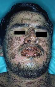Stevens Johnson Syndrome Wikipedia