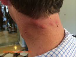 Maybe you would like to learn more about one of these? Imagenes De Picaduras De Chinches De Cama Cimex Hemiptera Cimicidae El Desinsectador Y Desratizador