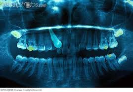 Panoramic Dental X Ray Showing A Crowding With A 10 Years Old Child Characterized By The Overlapping Of The Inciso Wisdom Teeth Wisdom Tooth Extraction Dental