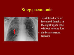 The ap lordotic projection is often used to evaluate suspicious areas within the lung apices that appeared obscured by overlying soft tissue, upper ribs or the clavicles on previous chest views (e.g. Chest X Ray In Common Respiratory Diseases Ppt Download
