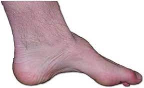Charcot Marie Tooth Disease Wikipedia