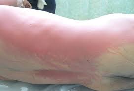 Some people, especially the elderly, may not show typical signs of infection. Sepsis Hautzeichen The Mottling Score Marmorierung In Der Sepsis Yema In Diesem Filmbeitrag Von Faszination Wissen Konnt Ihr Sehr Anschaulich Sehen Was Bei Einer Sepsis Passiert Sepsis