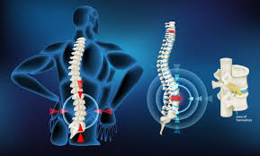 Pilates para hérnia de disco - Alves Pilates Brasil