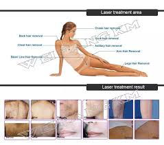 Then our full body and half body laser hair removal combinations are the perfect choice for you! Body Laser Hair Removal Cost Off 63 Online Shopping Site For Fashion Lifestyle