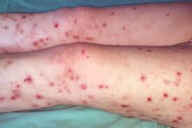 Image result for skin rash acute hiv infection