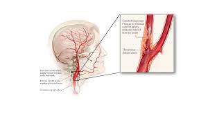 Both the right and left common carotid arteries divide into the external and internal carotid arteries at the carotid bifurcation. Carotid Artery Disease Reduce Stroke Risk Maryland Vascular