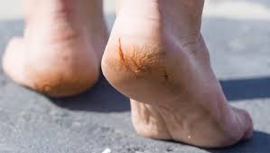 Mallet toes — when the toes bend down at the joint closest to the tip of the toe. Why Are My Heels Splitting And Cracking West Berkshire Foot Clinic