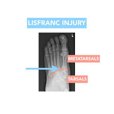 However, most athletes are able to successfully. Flow Physio Co Lisfranc Injuries