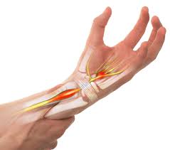 Carpal Tunnel Syndrome Upswing Health