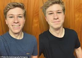 Robert irwin wins award (should be the headline, rather than, steve irwin's son). Robert Irwin Looks Like A Chipmunk As He Reveals He Has Had His Wisdom Teeth Removed Daily Mail Online