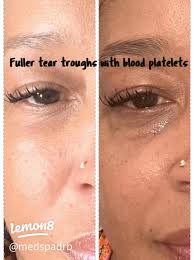 38 top Tear Trough Filler ideas in 2025