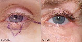 Find facts and statistics for reporting about skin cancer. Skin Cancer And Melanoma Reconstruction And Removal Dr Viggiano