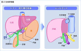 Www を検索 Nikkeibp Co Jp を検索 肝がんとともに 肝がんの治療を受ける方へ 外科的治療について 肝がんの治療では 手術による切除 が代表的な治療法の一つです 肝がんの進行度別の治療アルゴリズム 参照 肝臓を切除する方法には がんの進行