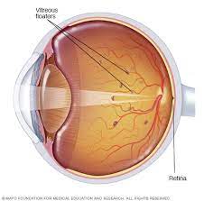 What does it mean if you see black spots. Eye Floaters Symptoms And Causes Mayo Clinic
