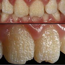 What Is Amelogenesis Imperfecta A Richmond Dental Center Facebook