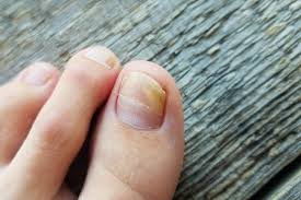 Image result for Yellow nail syndrome feet