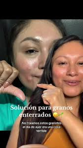 Como siempre tú muy bien Tea tree, excelente servicio 👌🏼 #granosenlacara  #granosenterrados #teatree #secargranitos #soluciongranos #drctuna  #drctunaskincare
