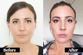 Browse botox before & after photos shared by doctors on realself. This Is Why I Got Botox For Tmj Jaw Muscles She Said Tmj Jaw Exercises Tmj Botox Migraine