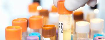 And if that is not possible, ensure it is not kept at room temperature. Urinalysis