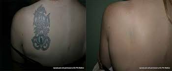 Laser tattoo removal training australia. Acd A Z Of Skin Tattoo Removal