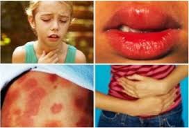 Image result for Anaphylaxis