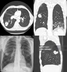 Image result for lung cancer xray