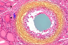 Image result for Thyroiditis