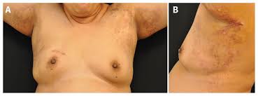 Image result for Intertrigo under breasts