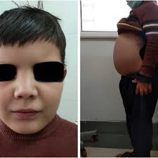 Ultrasonographic findings of the first fetus (Ⅱ1) at 23 weeks were (A)...