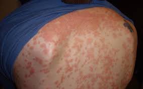 O tratamento da psoríase gutata utiliza as mesmas classes medicamentosas que a psoríase em placas, os cremes medicamentosos. Psoriase Gutata 1 Como Identificar 2 Como Controlar