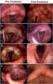 Image result for Chronic Laryngitis