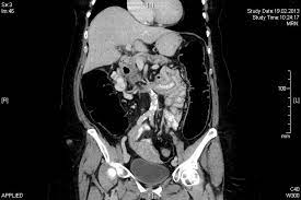 Ein darmverschluss oder ileus ist eine lebensgefährliche akute darmerkrankung. Darmverschluss Ileus Spital Thurgau Ag