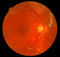The best way to preserve vision is through annual, detailed eye exams with a doctor who specializes in your unique eye condition. Diabetic Retinopathy Dr Mr Shahram Kashani