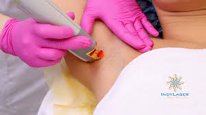 Laser treatments are a popular method of hair removal, but the cost of laser hair removal may be prohibitive for some individuals. Armpit Laser Hair Removal Cost Information And Everything Else Indy Laser