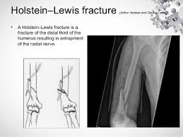 Holstein Lewis Fracture Radial Nerve Injury Radial Nerve Shoulder Dislocation Thoracic Vertebrae