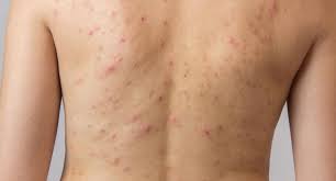 Foliculitis Pelos Enquistados Y Depilacion Laser Me Puede Ayudar