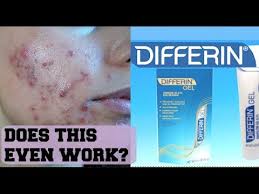 I Tried Differin Gel For One Week And This Is The Results Review On Adapalene Gel Youtube
