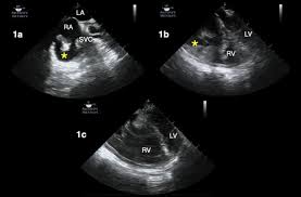 Richard tee was born on november 24, 1943 in brooklyn, new york, usa. Critical Care Transesophageal Echocardiography In Patients During The Covid 19 Pandemic Journal Of The American Society Of Echocardiography