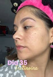 Fase de Purga de Tretinoína: Día 35