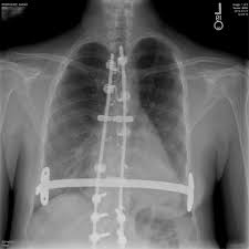 Pectus excavatum is sometimes considered to be cosmetic; Titanium Back Rods For Scoliosis Correction Chest Bar For Pectus Excavatum Correction Imgur