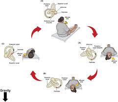 Image result for Canalith Repositioning Procedure